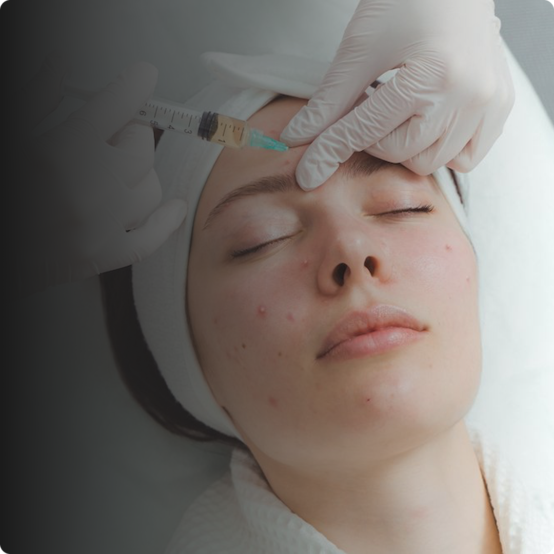 acne clear program